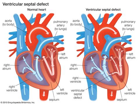lv dysfunction meaning